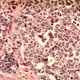 Células cancerígenas. Wikimedia Commons